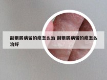 副银屑病留的疤怎么治 副银屑病留的疤怎么治好