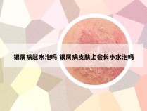 银屑病起水泡吗 银屑病皮肤上会长小水泡吗