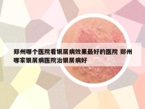 郑州哪个医院看银屑病效果最好的医院 郑州哪家银屑病医院治银屑病好