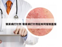 银屑病打针剂 银屑病打针剂后如何报销医保