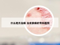 什么地方治癣 治皮肤癣的专科医院