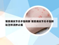 银屑病关节炎手指和脚 银屑病关节炎手指脚趾怎样消肿止痛