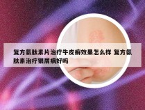 复方氨肽素片治疗牛皮癣效果怎么样 复方氨肽素治疗银屑病好吗