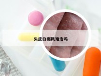 头皮白癜风难治吗