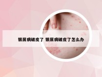 银屑病破皮了 银屑病破皮了怎么办