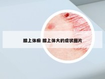 腺上体癣 腺上体大的症状图片