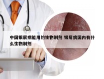 中国银屑病能用的生物制剂 银屑病国内有什么生物制剂