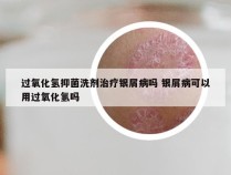 过氧化氢抑菌洗剂治疗银屑病吗 银屑病可以用过氧化氢吗