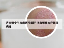 济南哪个牛皮癣医院最好 济南哪里治疗银屑病好