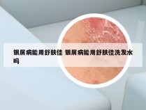 银屑病能用舒肤佳 银屑病能用舒肤佳洗发水吗