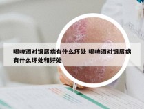 喝啤酒对银屑病有什么坏处 喝啤酒对银屑病有什么坏处和好处