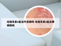 吃维生素e能治牛皮癣吗 吃维生素e能去黄褐斑吗