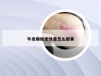 牛皮癣蜕皮快是怎么回事