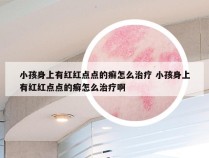 小孩身上有红红点点的癣怎么治疗 小孩身上有红红点点的癣怎么治疗啊