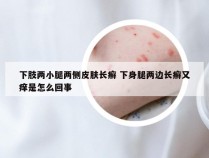 下肢两小腿两侧皮肤长癣 下身腿两边长癣又痒是怎么回事