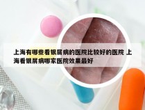 上海有哪些看银屑病的医院比较好的医院 上海看银屑病哪家医院效果最好