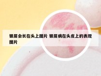 银屑会长在头上图片 银屑病在头皮上的表现图片