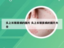 头上长银屑病的图片 头上长银屑病的图片大全