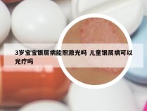 3岁宝宝银屑病能照激光吗 儿童银屑病可以光疗吗