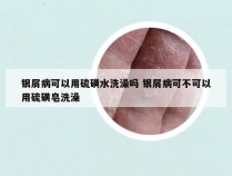 银屑病可以用硫磺水洗澡吗 银屑病可不可以用硫磺皂洗澡