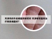 天津市的牛皮癣医院哪家好 天津哪家医院治疗银屑病最好?