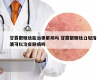 甘露聚糖肽能治银屑病吗 甘露聚糖肽口服溶液可以治皮肤病吗