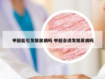 甲醛能引发银屑病吗 甲醛会诱发银屑病吗