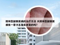 斑块型副银屑病的治疗方法 大斑块型副银屑病有一辈子不发生恶变的吗?