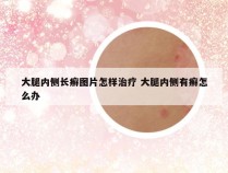 大腿内侧长癣图片怎样治疗 大腿内侧有癣怎么办