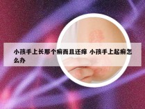 小孩手上长那个癣而且还痒 小孩手上起癣怎么办