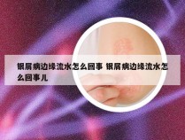 银屑病边缘流水怎么回事 银屑病边缘流水怎么回事儿