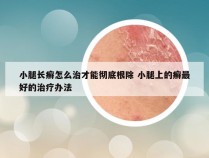 小腿长癣怎么治才能彻底根除 小腿上的癣最好的治疗办法