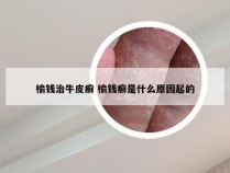 榆钱治牛皮癣 榆钱癣是什么原因起的