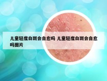 儿童轻度白斑会自愈吗 儿童轻度白斑会自愈吗图片