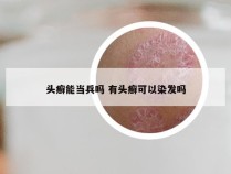 头癣能当兵吗 有头癣可以染发吗