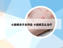 小腿癣会不会传染 小腿癣怎么治疗