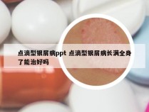 点滴型银屑病ppt 点滴型银屑病长满全身了能治好吗