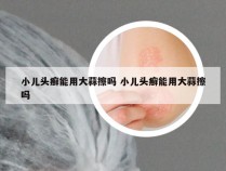 小儿头癣能用大蒜擦吗 小儿头癣能用大蒜擦吗