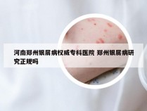 河南郑州银屑病权威专科医院 郑州银屑病研究正规吗