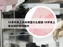 50多岁身上长白斑是什么原因 50岁身上有白斑的原因图片