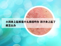 小孩身上起癣是什么原因咋办 孩子身上起了癣怎么办