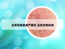 丘疹型银屑病严重吗 丘疹状银屑病