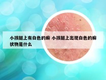 小孩腿上有白色的癣 小孩腿上出现白色的癣状物是什么