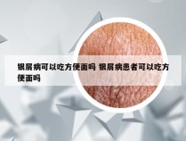 银屑病可以吃方便面吗 银屑病患者可以吃方便面吗