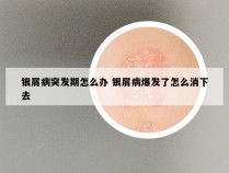 银屑病突发期怎么办 银屑病爆发了怎么消下去