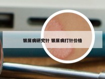 银屑病研究针 银屑病打针价格