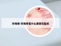 珍珠癣 珍珠疹是什么原因引起的