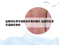 盐酸特比萘芬凝胶治疗癣的图片 盐酸特比萘芬凝胶好用吗