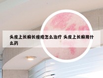 头皮上长癣长痤疮怎么治疗 头皮上长癣用什么药