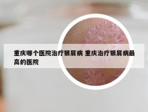 重庆哪个医院治疗银屑病 重庆治疗银屑病最高的医院